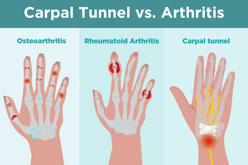 Carpal Tunnel vs. Arthritis