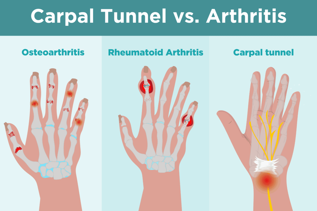 Carpal Tunnel Syndrome vs. Arthritis: What's the Difference?