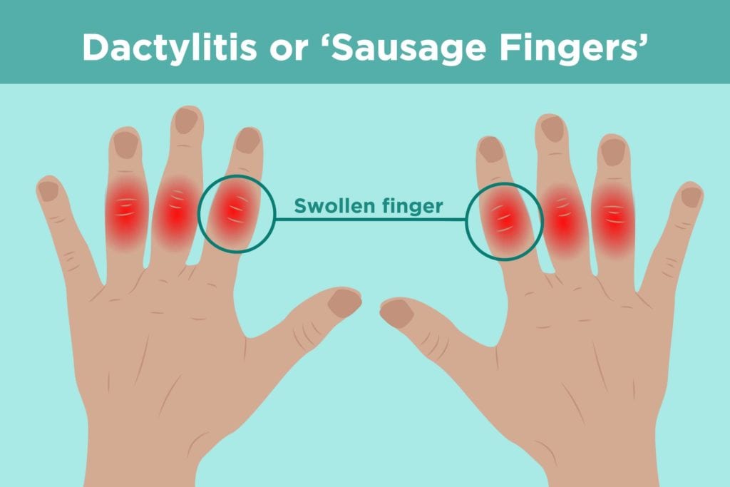 Dactylitis: An Arthritis Symptom