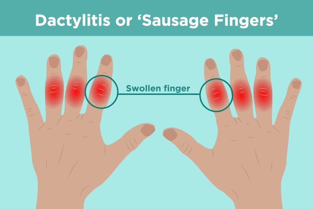 What Is Dactylitis? Understanding Symptoms,