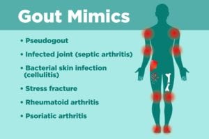 Causes of Gout  EmergeOrtho—Triangle Region