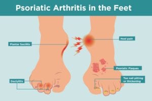 How Psoriatic Arthritis Affects Feet