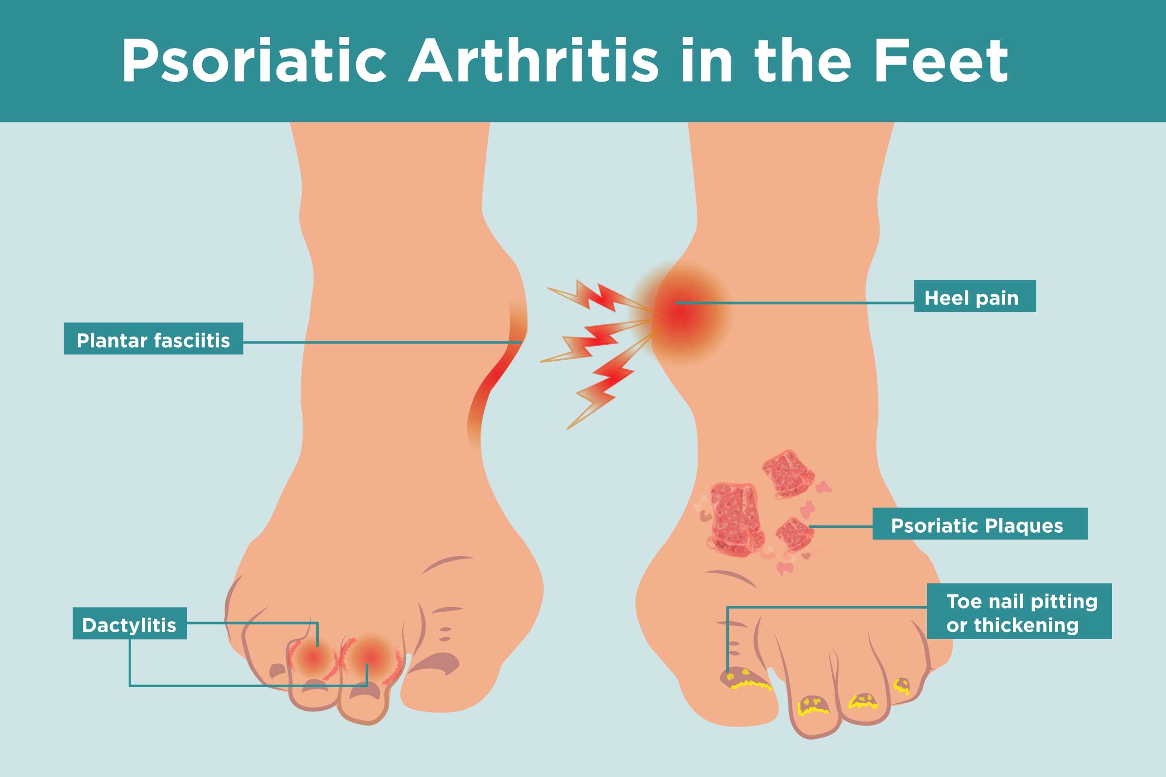 is psoriatic arthritis, a connective tissue disease)