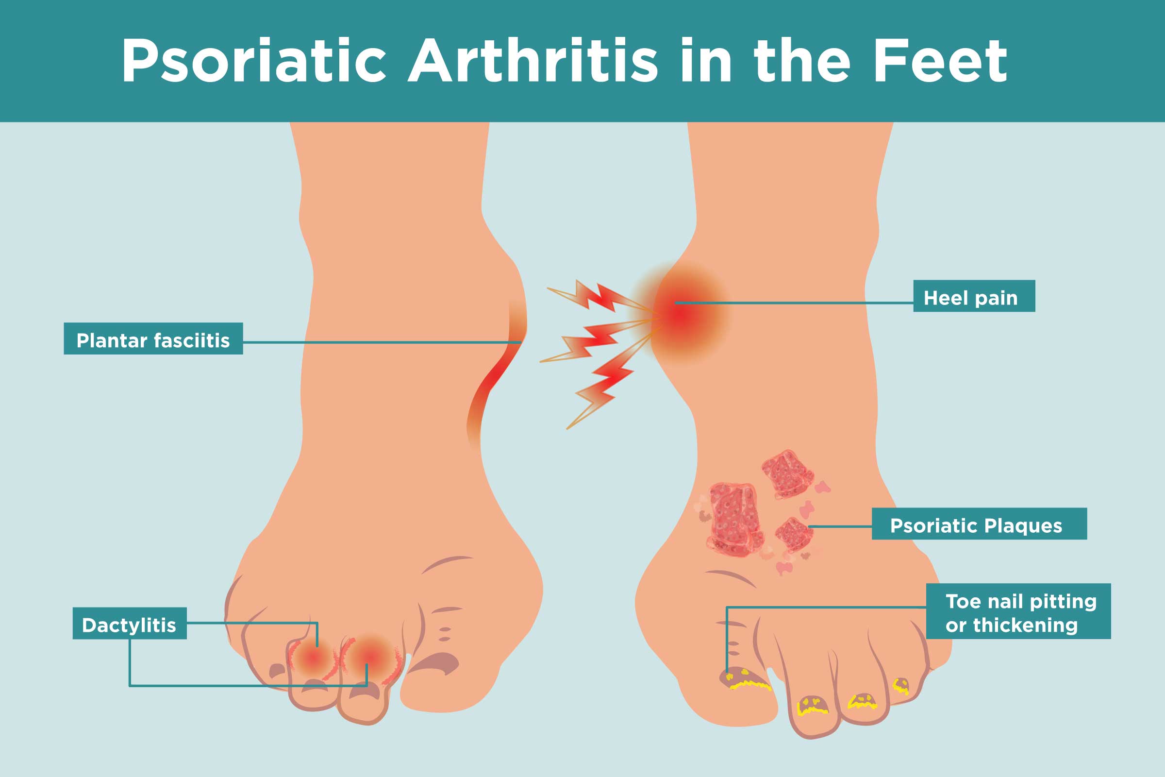 plaque psoriasis foot treatment