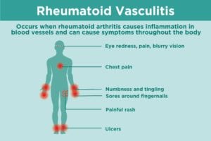 Rheumatoid Vasculitis