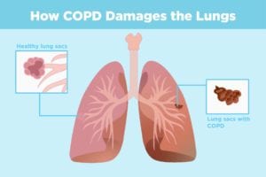 COPD and Arthritis