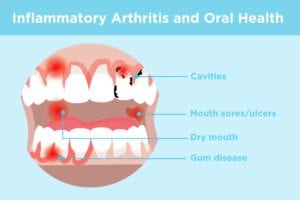 Inflammatory Arthritis and Oral Health