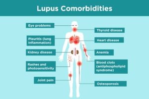 Lupus Comorbidities Infographic