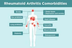 Rheumatoid Arthritis Comorbidities Infographic