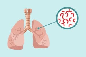 Tuberculosis and Arthritis