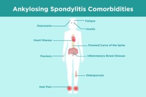 Ankylosing Spondylitis Comorbidities