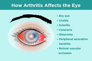 How Arthritis Affects the Eye
