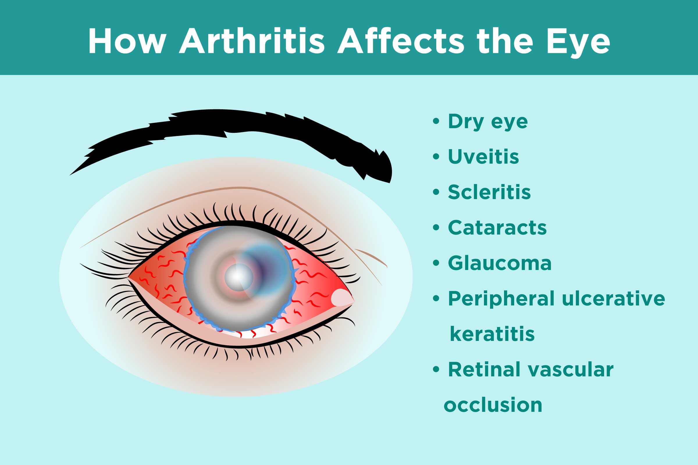 Common Eye Infections, Symptoms, Eye, Vision