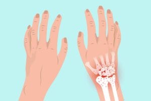 Arthritis in Wrist