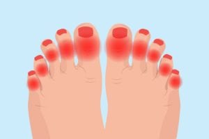 Arthritis in Toes