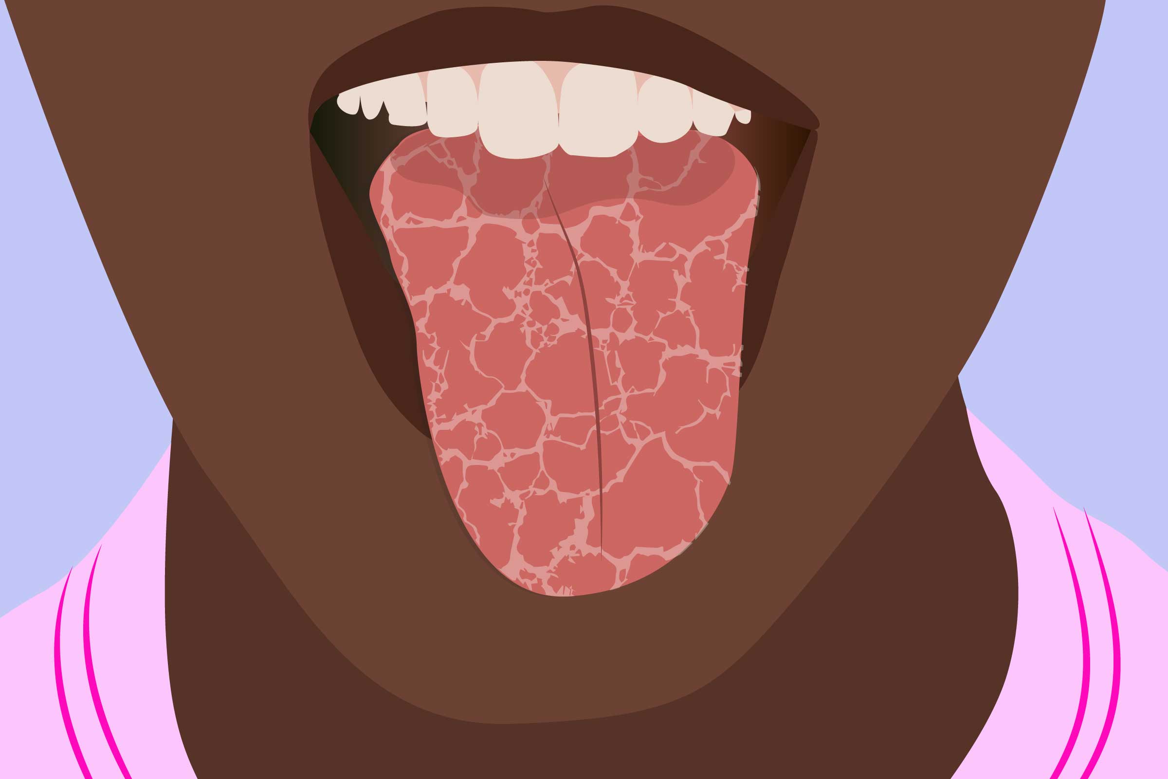 dry mouth and throat symptoms