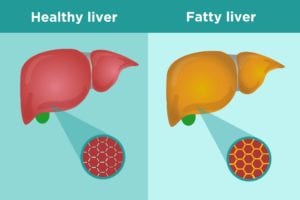 Fatty Liver Disease