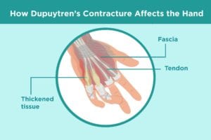 How Dupuytrens Affects the Hand