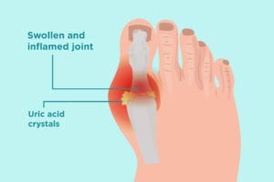 Uric Acid Crystals in Gout