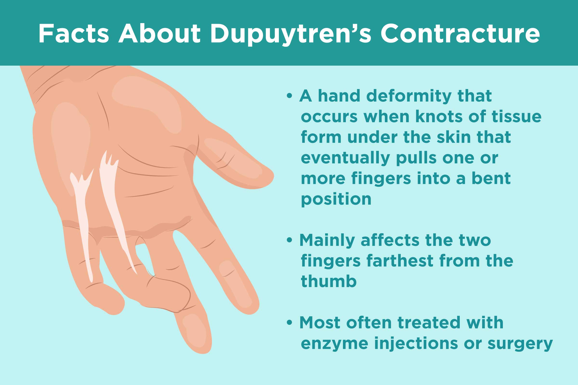 What Are Viking Fingers?, Dupuytren's Contracture