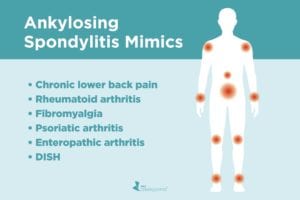 Ankylosing Spondylitis Misdiagnoses