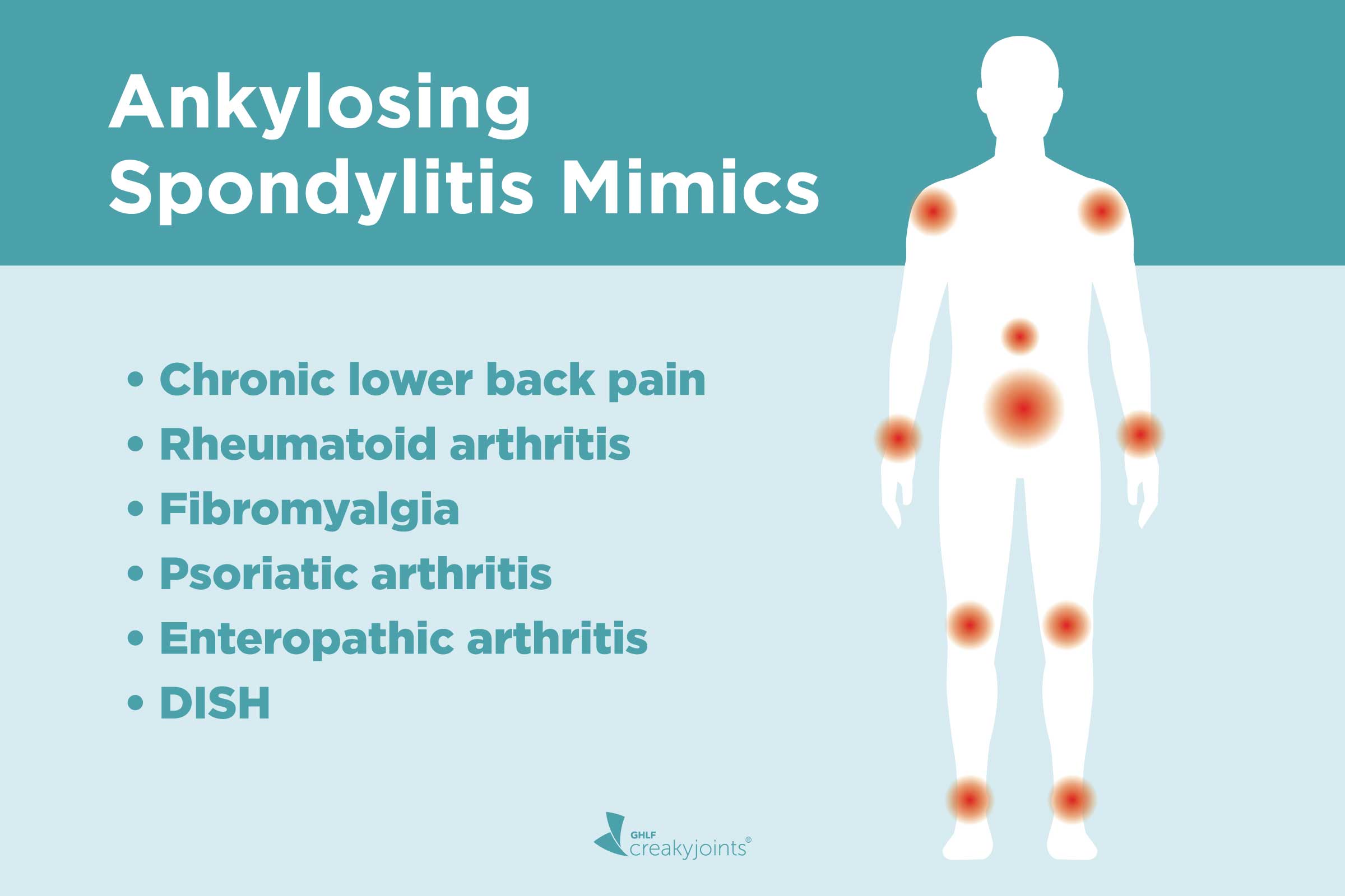 Ankylosing Spondylitis Misdiagnosis: Diseases AS Can Be Mistaken For