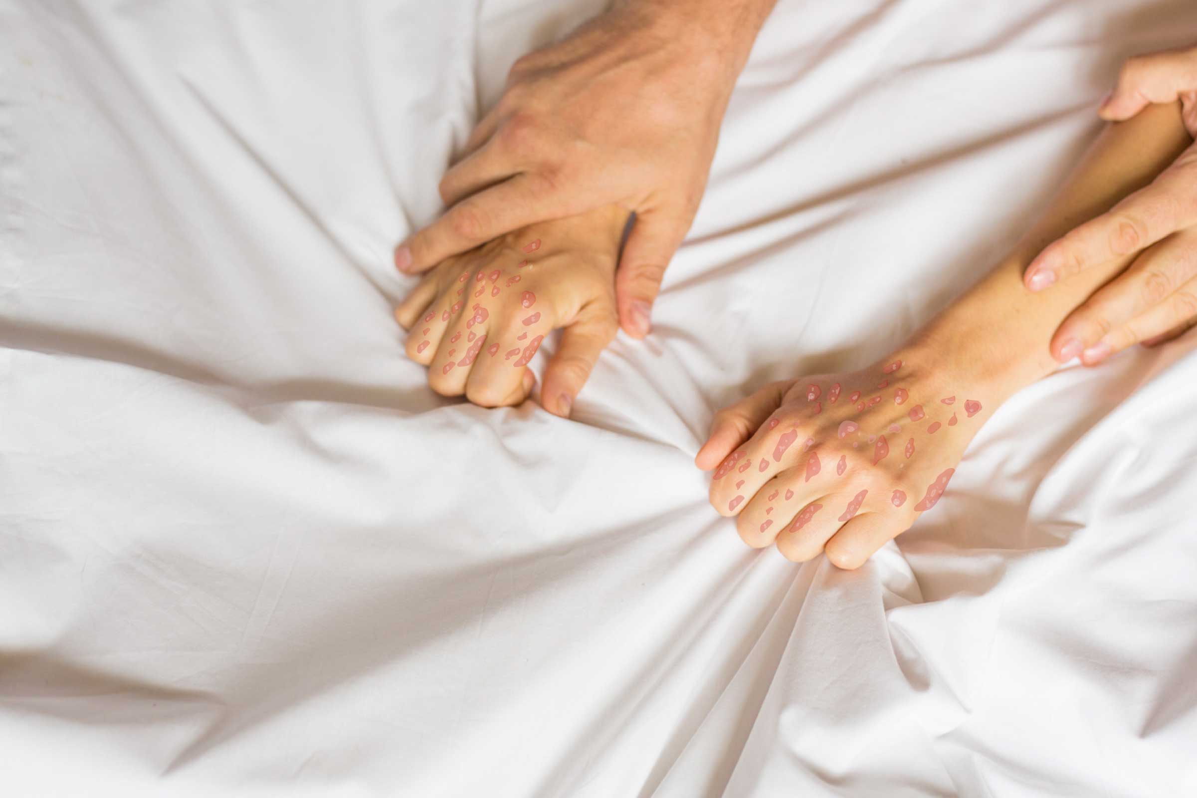 Psoriasis Linked to Sexual Dysfunction