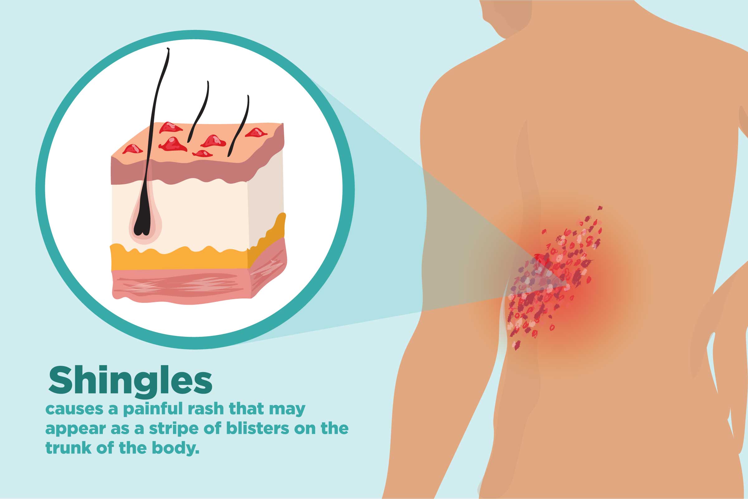 shingles early symptoms