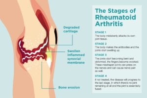 Rheumatoid arthritis stages,