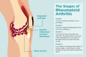 rheumatoid arthritis)