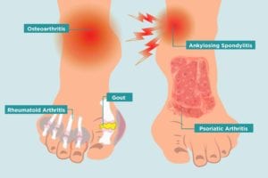 Arthritis in Your Symptoms, and Treatment