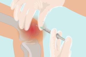 cortisone shot in knee