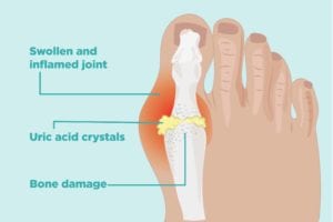 How Gout Causes Bone Damage
