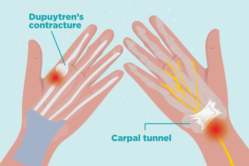 Is My Hand Pain Caused by Arthritis or Carpal Tunnel Syndrome