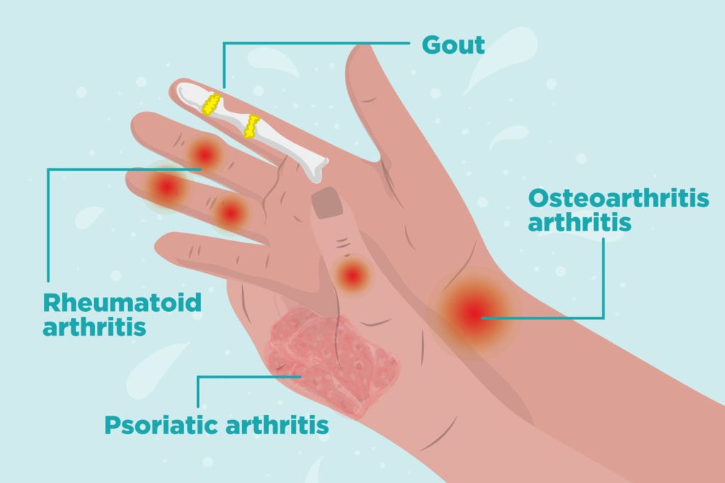 Rheumatoid Arthritis in the Hands: Symptoms and Treatments