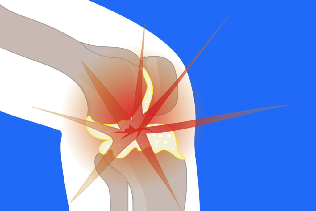 Knee Osteoarthritis