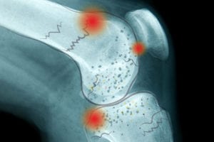 How Steroid Medications Affect Bone Health