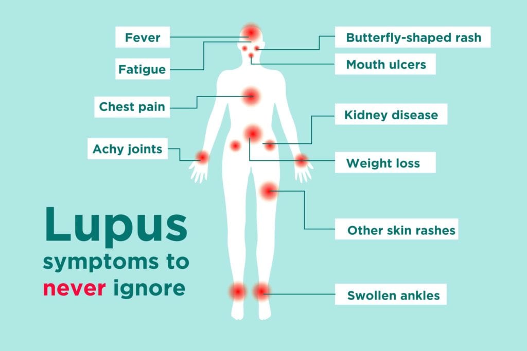 Lupus disease
