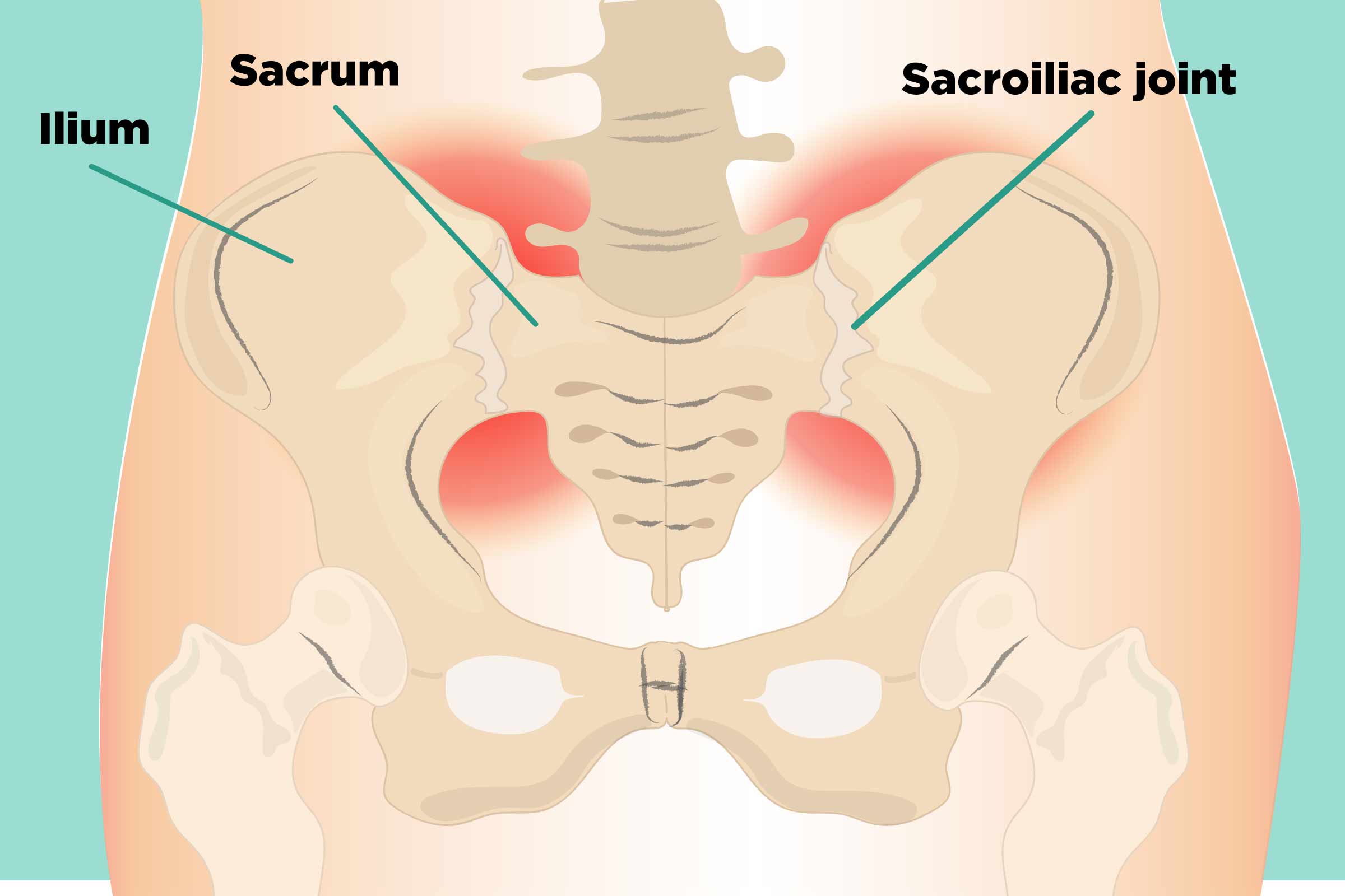 garn gravid amerikansk dollar Sacroiliac (SI) Joint Pain: Understanding Causes, Symptoms, Treatment