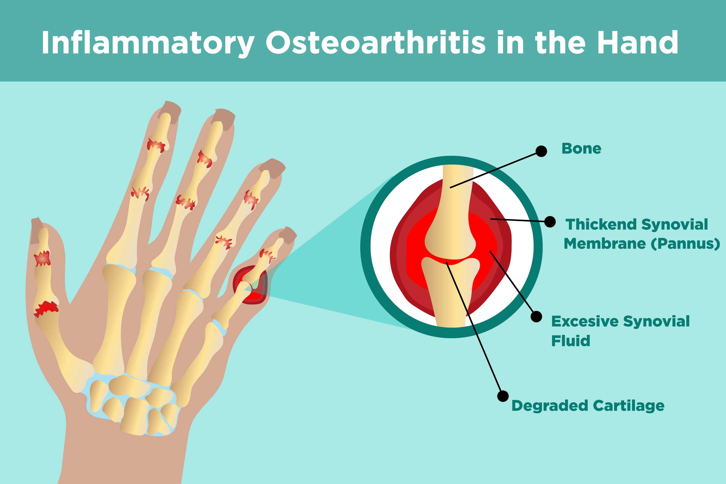 osteoarthritis polyosteoarthritis