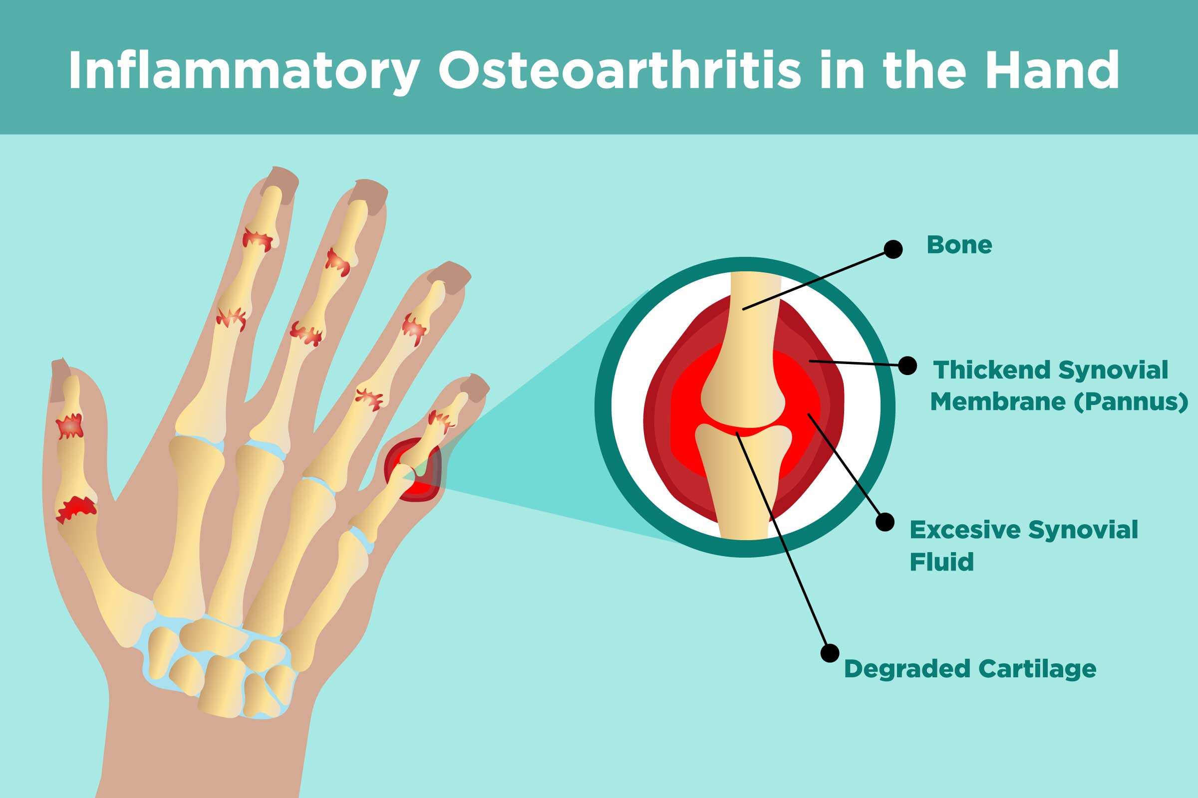 Osteoarthritis vs. rheumatoid arthritis - Mayo Clinic