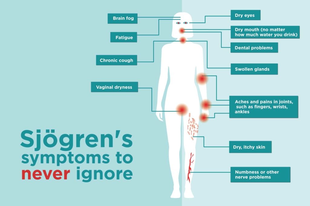 Sj gren s Syndrome Symptoms You Might Be Ignoring