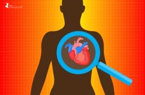 Heart Disease Risk in African Americans with Lupus
