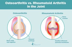 Osteoarthritis vs Rheumatoid in the Joint