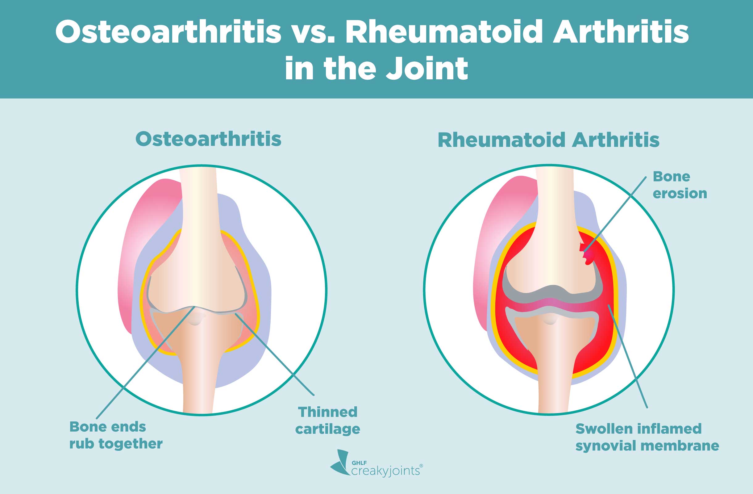 What's the difference between arthritis and arthrosis?