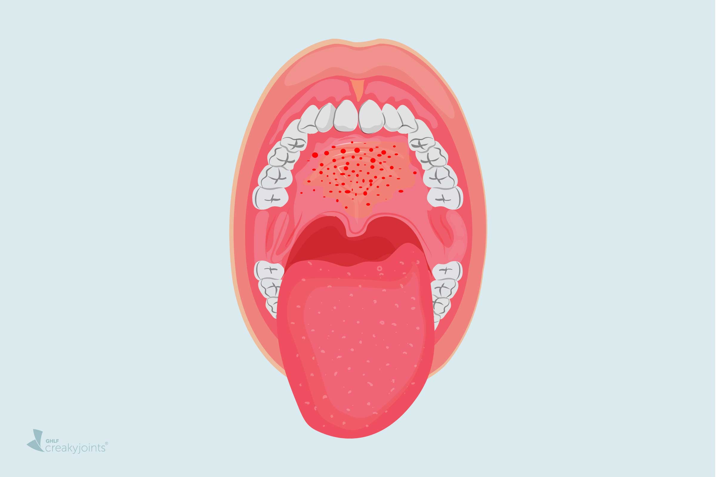 0720 COVID Mouth Lesions Logo