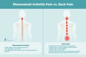 Rheumatoid Arthritis Pain vs. Back Pain