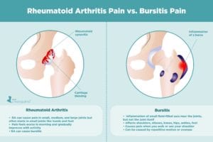 Rheumatoid Arthritis Pain vs. Bursitis Pain