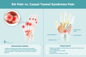 Rheumatoid Arthritis Pain vs. Carpal Tunnel Syndrome Pain