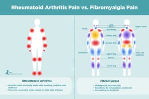 Rheumatoid Arthritis Pain vs. Fibromyalgia Pain